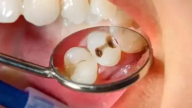 Dişlerinde çürük mü var? Ağızdaki sorunlar ciddi hastalıklara yol açıyor! Uzmanlar uyardı...