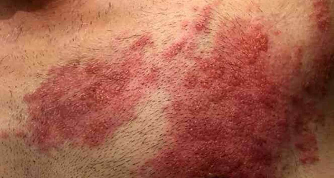 Cilt sağlığınız tehlikede! Zona hastalığının en büyük düşmanı: Stres... Uzmanlar uyarıyor: "Bağışıklığınızı düşürüyor, zihin sağlığınızı da etkiliyor" 1