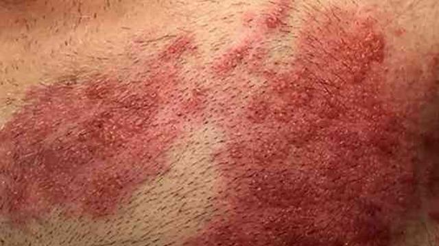 Vücudunuzda uyuyan virüs: Merak edilen zona hastalığı nedir? Stres ve yorgunluk habercisi...