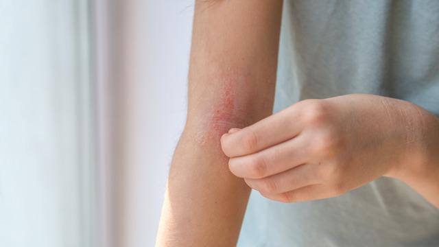 Atopik dermatit nedir? Atopik dermatit neden olur, nasıl geçer?
