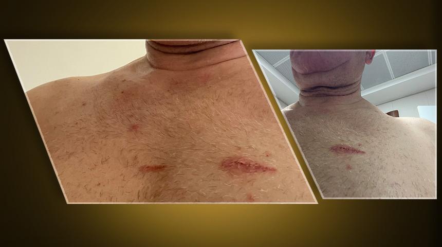 CHP'li Mahmut Tanal vücudundaki izleri 'Bu izler; demokrasi ve hukuka saldırının izleridir' notuyla paylaştı! 