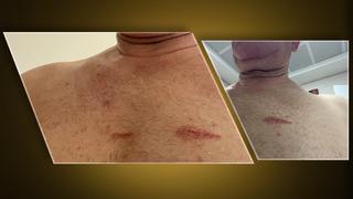 CHP'li Mahmut Tanal vücudundaki izleri 'Bu izler; demokrasi ve hukuka saldırının izleridir' notuyla paylaştı! 