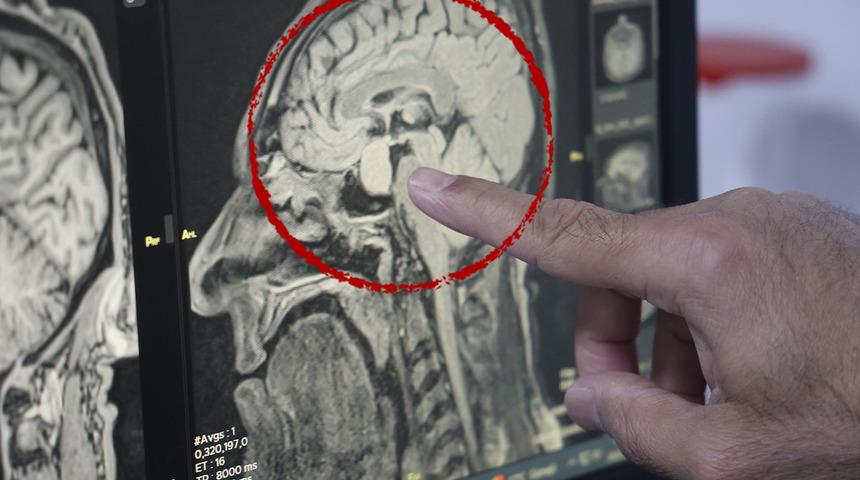 Türkiye'de sağlıkta bir ilk! Kapalı yöntemle beyindeki tümör alındı: "Burundan müdahale edildi"