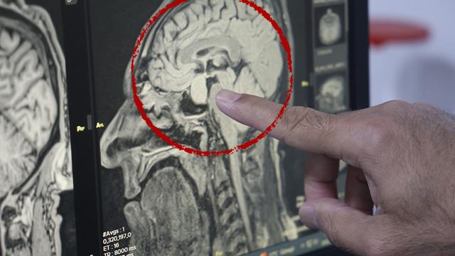 Türkiye'de sağlıkta bir ilk! Kapalı yöntemle beyindeki tümör alındı: Burundan müdahale edildi