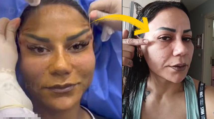 Güzellik merakı kabusu oldu! Yaptırdığı estetik 3 gün sonra bozulmaya başladı, hayatını kararttı: "Özgüvenim ve psikolojim gitti"