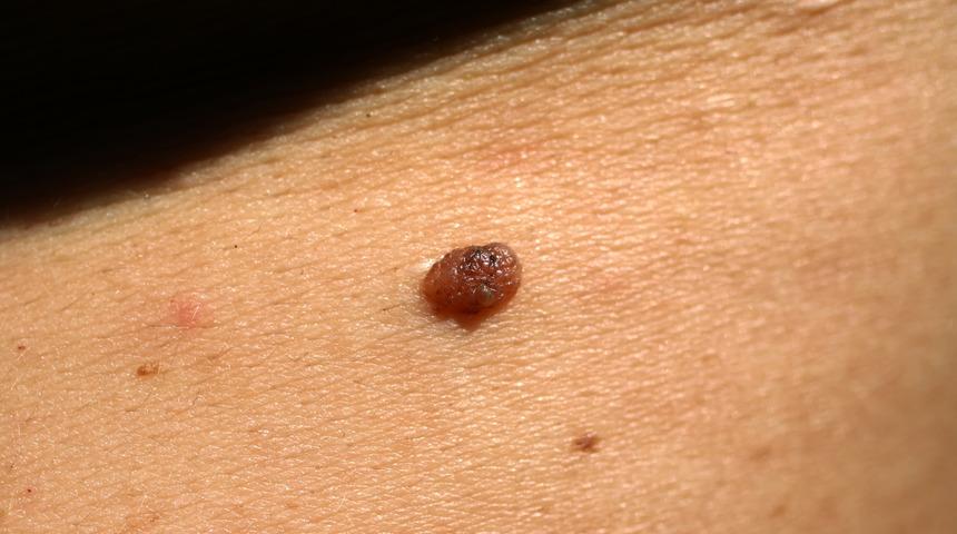 Et beni neden olur? Et beni nasıl geçer veya alınır? Et beni nasıl düşer?