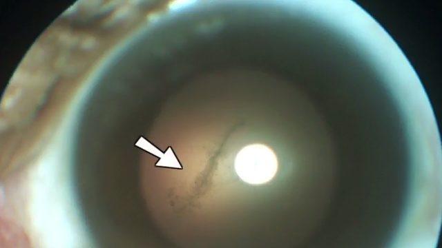 Gözünden beyin yiyen solucan çıktı!