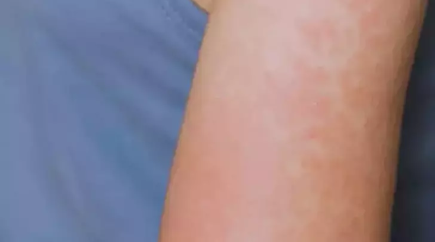 Vakalar arttı: Kırmızı alarm! Teksas'ta sonra Kansas'ta da kızamık yayılıyor