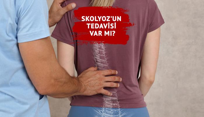 Skolyoz'un tedavisi var mı? Çocukluktan yetişkinliğe omurga eğriliğinin etkileri ve çözümlerini uzman doktor açıkladı...