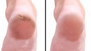 Topuk çatlağına ne iyi gelir? Topuk çatlağı tedavisinde evde uygulayabileceğiniz yöntemler 