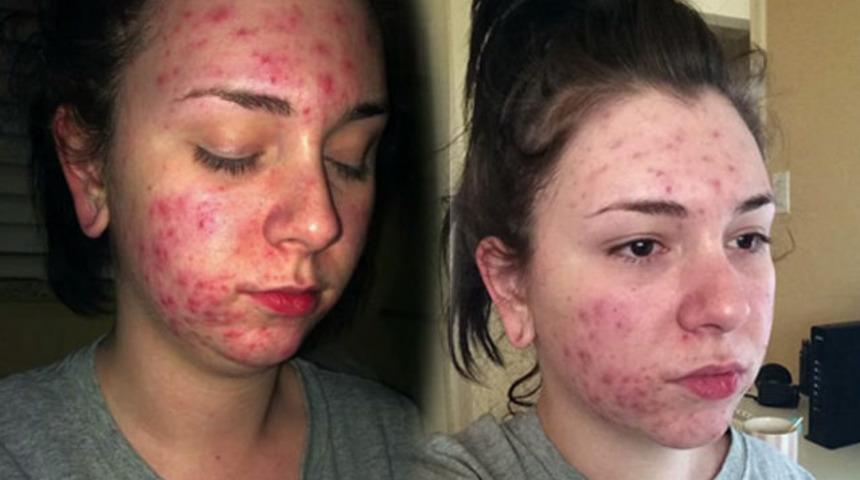 Spiral taktırdı y&uuml;z&uuml; tanınmaz hale geldi