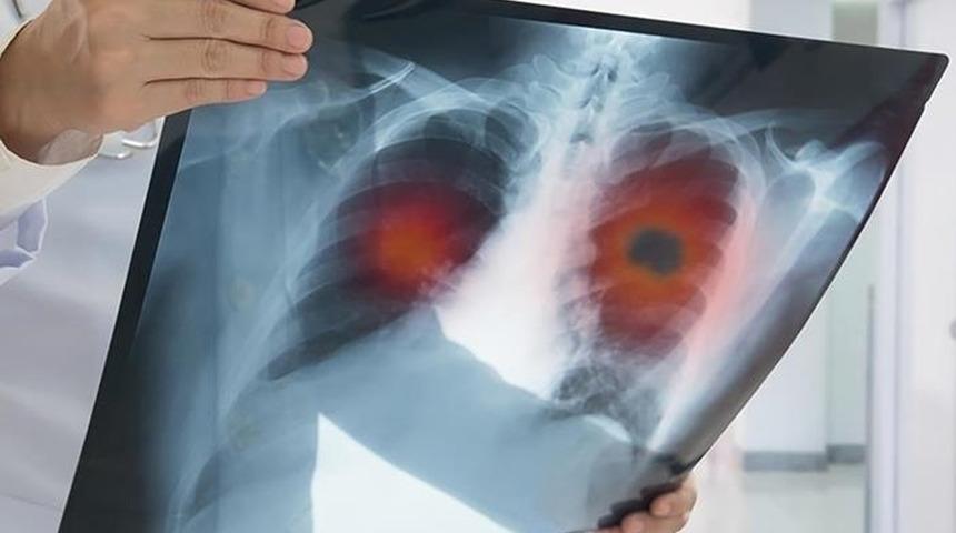 Akciğer kanserinden korunmanın 7 yolu: Uzmandan çarpıcı açıklamalar...