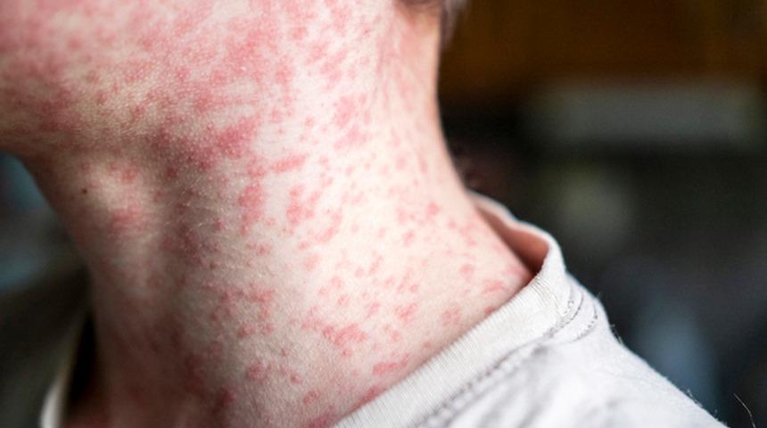 ABD'de kızamık yeniden gündemde! 600'den fazla vaka kaydedildi: Ölüm sayısı arttı! Donald Trump açıklama yaptı...