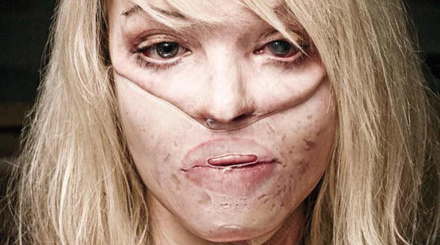 &Ouml;nce tecav&uuml;ze sonra asitli saldırıya uğradı... Şimdiki halini g&ouml;renler g&ouml;zlerine inanamıyor