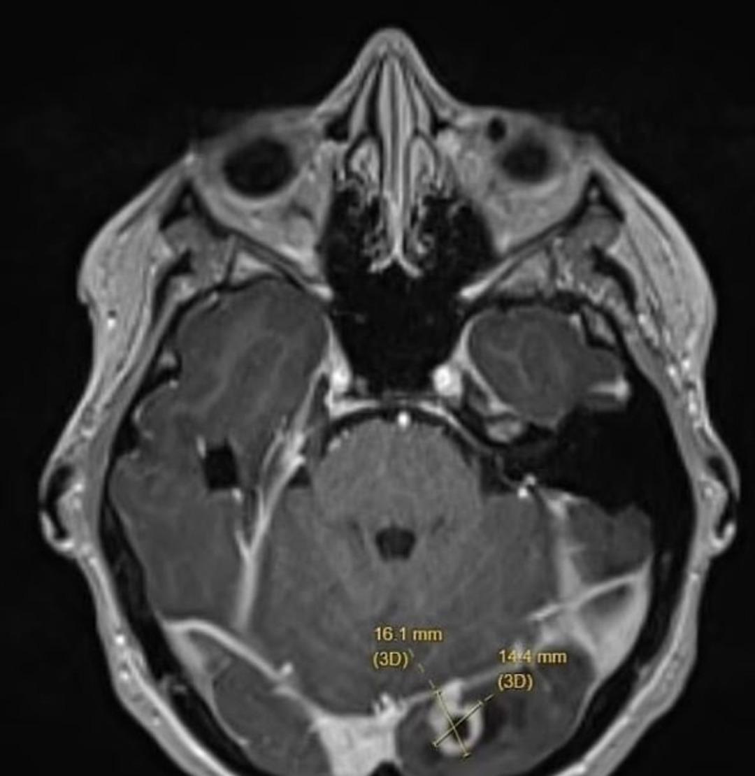 Işığı gördü, ölümcül hastalığı olduğunu öğrendi! Çocukluğundan beri o belirtiyi önemsememiş... 1