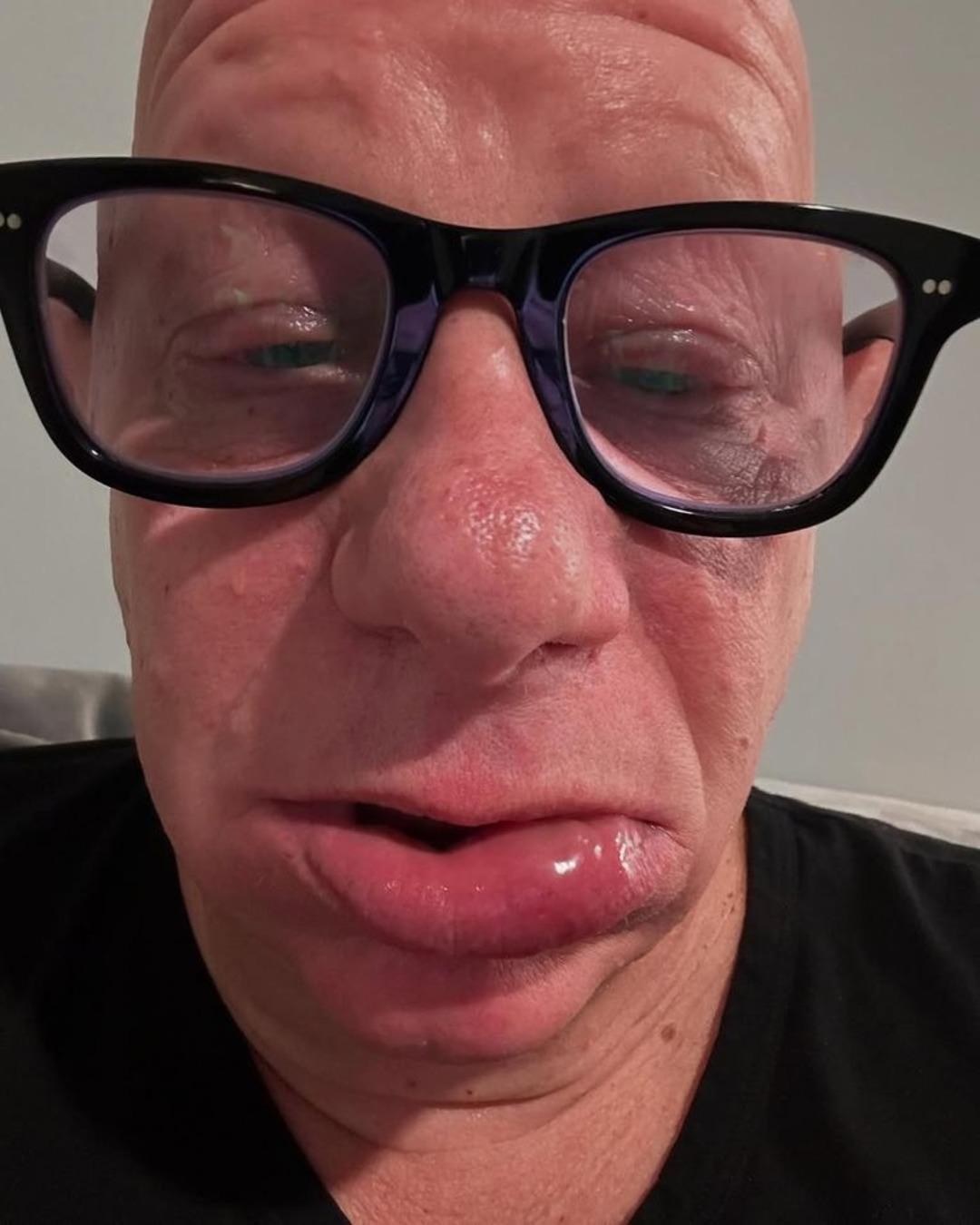 Ünlü komedyen Jeff Ross dondurma yedikten sonra hastanelik oldu! Yüzünün son halini paylaştı 3