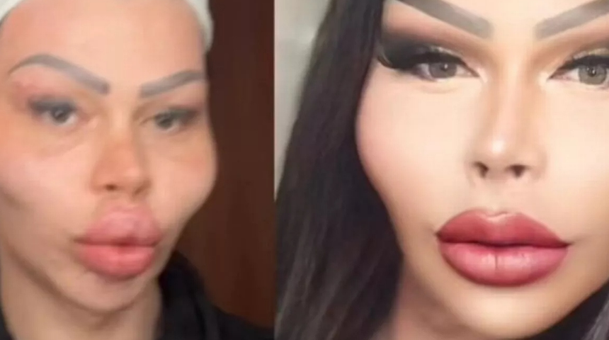 Yüzden fazla estetik operasyon geçirdi ama durmuyor! Bakın hedefi neymiş...