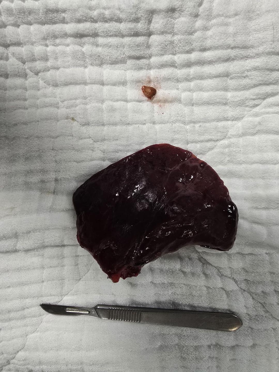 Karayemiş çekirdeği canını alıyordu: Akciğerinde çürümeye neden oldu! 1