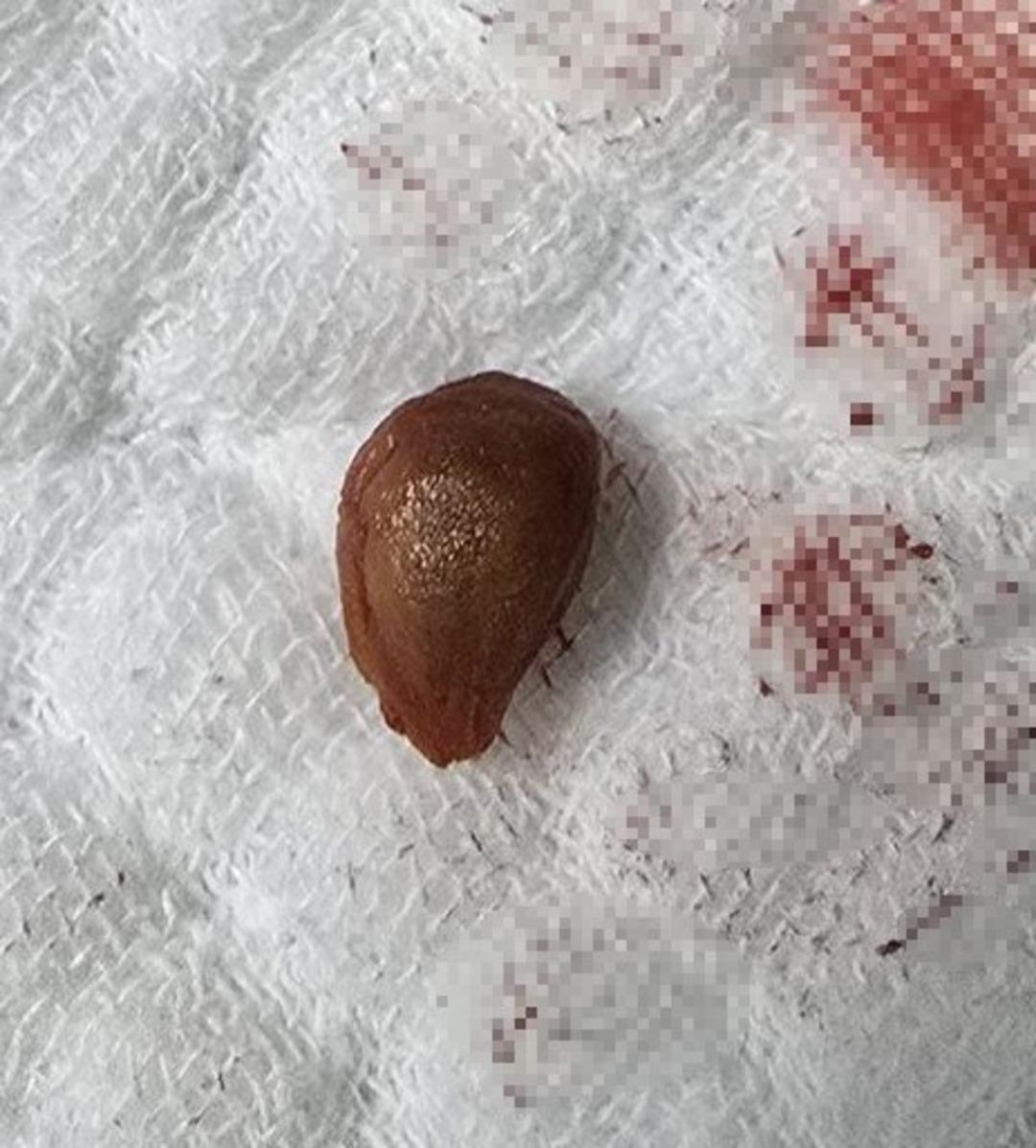 Karayemiş çekirdeği canını alıyordu: Akciğerinde çürümeye neden oldu! 2