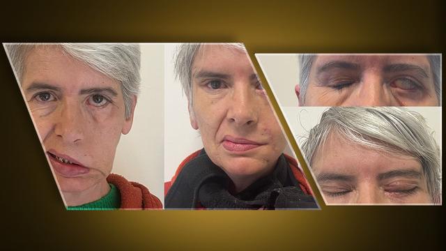 24 ayar altınla tedavi edildi, hayatı değişti! 41 yıl boyunca gözü açık uyuyan kadının umut dolu hikayesi...