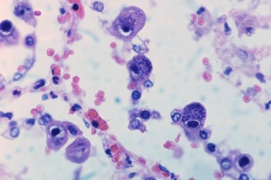 Cytomegalovirus_infection_resize
