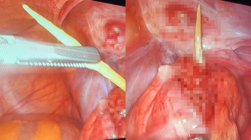 Karın ağrısının altından kürdan çıktı! Türkiye'de sadece 3 kişide bu vaka görülmüş...