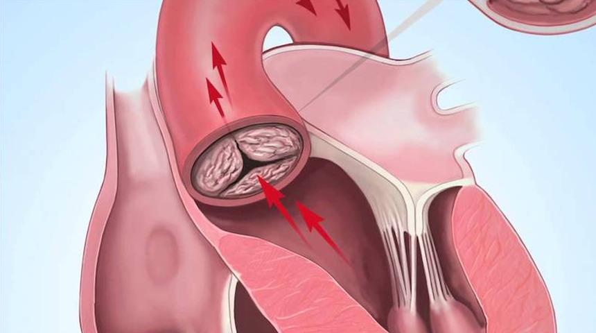 Aort yırtılması nedir, neden olur? Aort yırtılmasının tedavisi var mı?