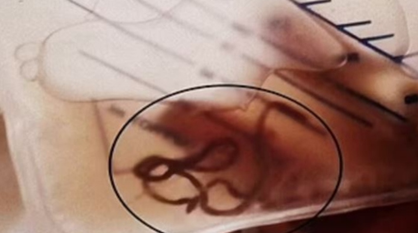 Çiğ çiğ yedi, idrarından solucan çıktı! Korkunç görüntü gündem oldu! Uzunluğu ise tam 30 santimetre