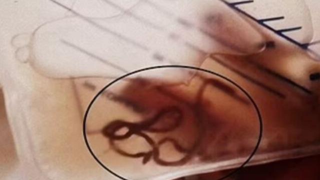 Çiğ çiğ yedi, idrarından solucan çıktı! Korkunç görüntü gündem oldu! Uzunluğu ise tam 30 santimetre