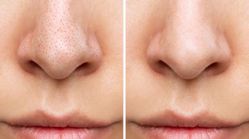 Siyah noktalara karşı iki doğal maske: Yulaf mı, yumurta akı mı? Siyah nokta ve gözeneklere çözüm olacak maskeler!