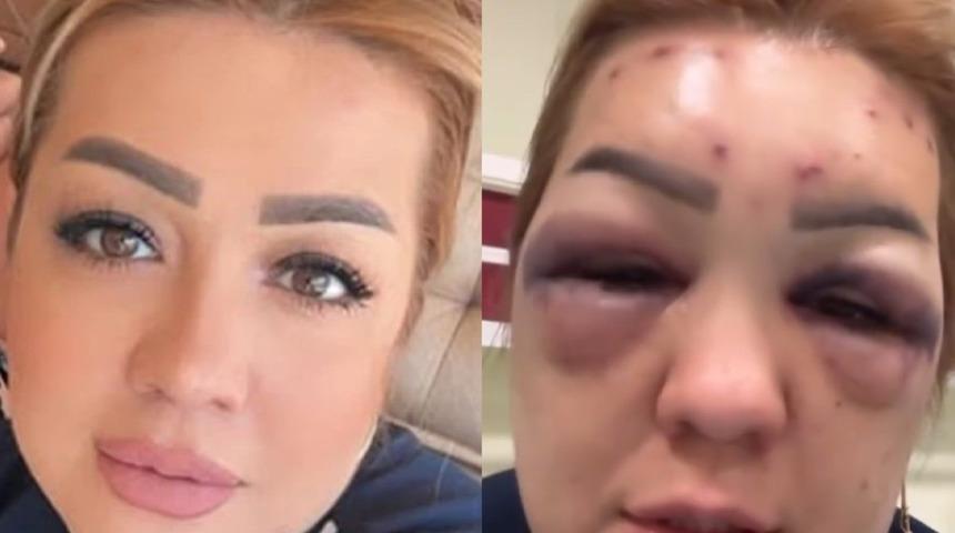 Güzelleşmek için o işlemi yaptırdı sonu hüsran oldu! Suratı tanınmaz hale geldi: "Dayak yemedim, botoks yaptırdım"