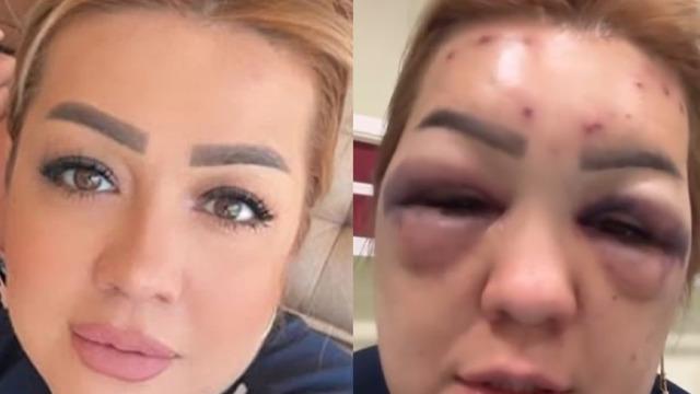 Güzelleşmek için o işlemi yaptırdı sonu hüsran oldu! Suratı tanınmaz hale geldi: Dayak yemedim, botoks yaptırdım