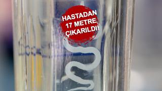 Organları yiyip öldürüyor! Avrupa'dan ABD'ye yayıldı, acil uyarı yapıldı! Bir hastadan 17 metre çıkarıldı...