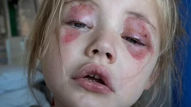 Annelere uyarı: Her evde kullanılıyor! 4 yaşındaki çocuk ısırınca kör oldu, hayatı mahvoldu