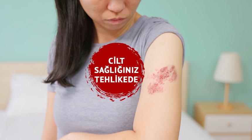 Cilt sağlığınız tehlikede! Zona hastalığının en büyük düşmanı: Stres... Uzmanlar uyarıyor: "Bağışıklığınızı düşürüyor, zihin sağlığınızı da etkiliyor"