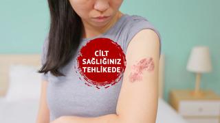 Cilt sağlığınız tehlikede! Zona hastalığının en büyük düşmanı: Stres... Uzmanlar uyarıyor: Bağışıklığınızı düşürüyor, zihin sağlığınızı da etkiliyor