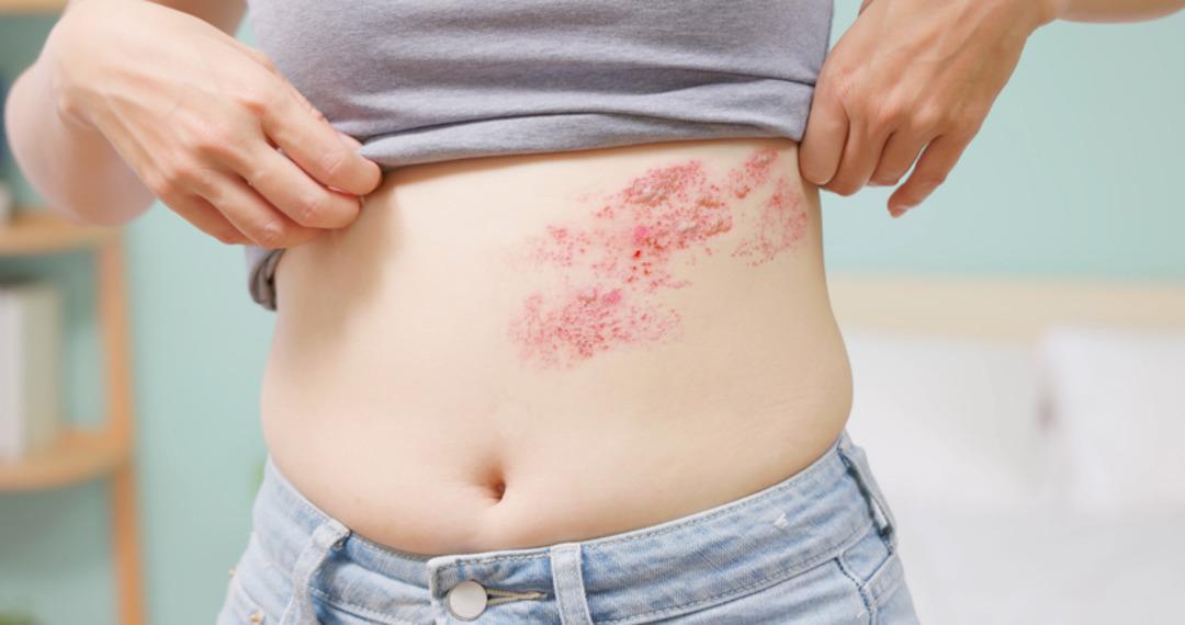 Cilt sağlığınız tehlikede! Zona hastalığının en büyük düşmanı: Stres... Uzmanlar uyarıyor: "Bağışıklığınızı düşürüyor, zihin sağlığınızı da etkiliyor" 2