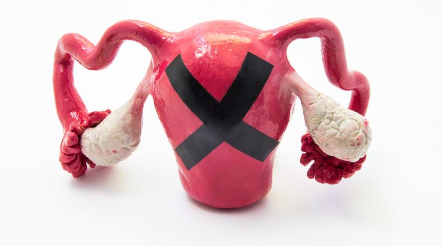 Çikolata kisti cinsel hayatı nasıl etkiliyor?