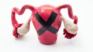 Çikolata kisti cinsel hayatı nasıl etkiliyor?