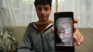 18 yaşındaki Yusuf 1,5 yıldır kafasında suç delili kurşunla yaşıyor! 'Sürekli ölüm korkusu yaşıyorum'