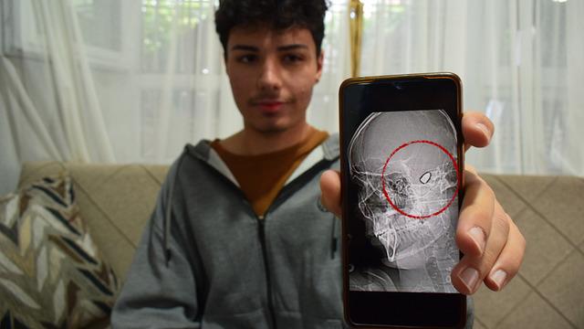 18 yaşındaki Yusuf 1,5 yıldır kafasında suç delili kurşunla yaşıyor! 'Sürekli ölüm korkusu yaşıyorum'