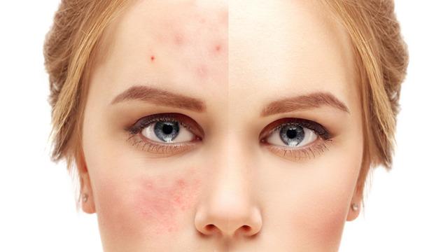 Sivilce ile karıştırmayın! Basit bir kızarıklık gibi başlıyor, yüzde iz bırakıyor: Rosacea hastalığı nedir?