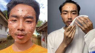 Mağazadan alıp o hatayı yaptı, sonu kötü oldu! Her yerinde kabarcıklar çıktı! Siz sakın yapmayın...