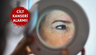 Cilt kanserinde korkutan artış! 