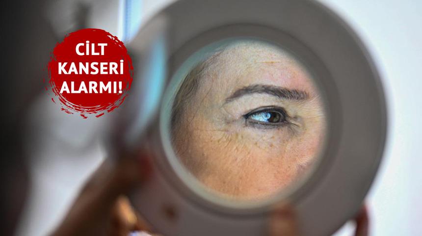 Cilt kanseri alarmı! Türkiye’de vakalar hızla artıyor: Solaryum, yaşlılık, güneş sessizce cildinizi hasta mı ediyor? Uzmanlar uyarıyor...