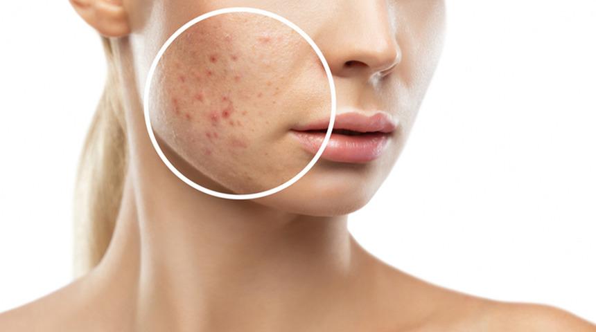 Akne tedavisinde çığır açan buluş: Sivilce aşısı üretildi! mRNA aşısı nedir?