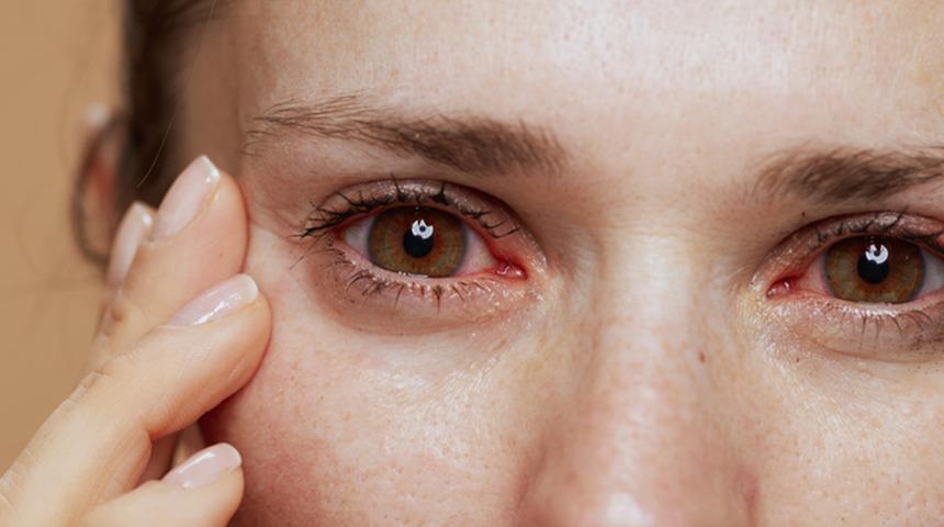 Zararsız gibi görünüyor ama hayatınızı etkiliyor! En sık görülen bahar alerjisi sorunu: Göz alerjisine dikkat! 