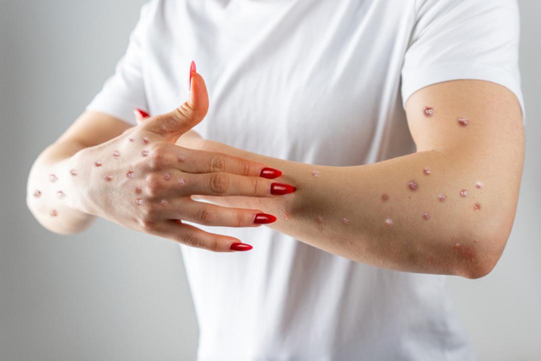 Pakistan da maymun çiçeği vakaları arttı! Ülkede 12 günlük kapanma ilan edildi 2