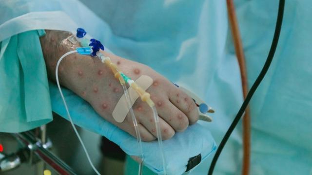 Pakistan'da maymun çiçeği vakaları arttı! Ülkede 12 günlük kapanma ilan edildi