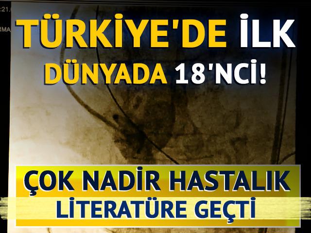 Çok nadir hastalık: Türkiye'de bir ilk, dünyada 18'nci vaka! Nefes darlığı diye hastaneye gitti tıp literatürüne girdi: 4 yaprakçıklı aort kapağı nedir?